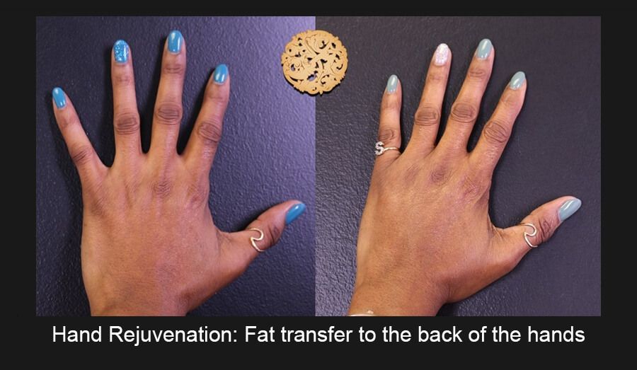 Hand Rejuvenation Before & After