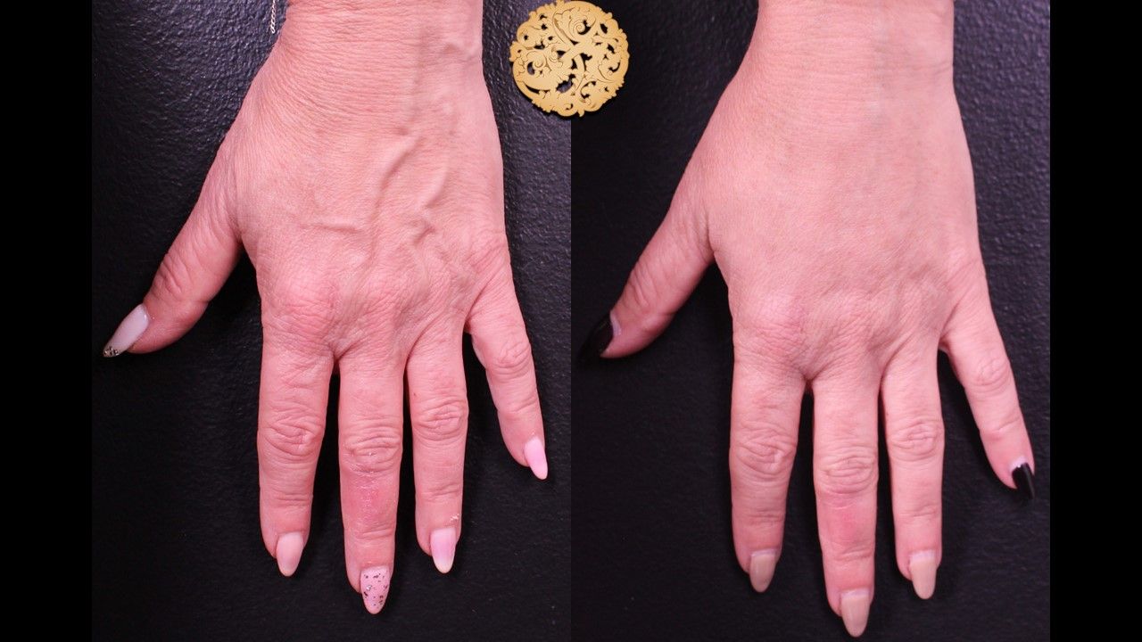 Hand Rejuvenation Before & After