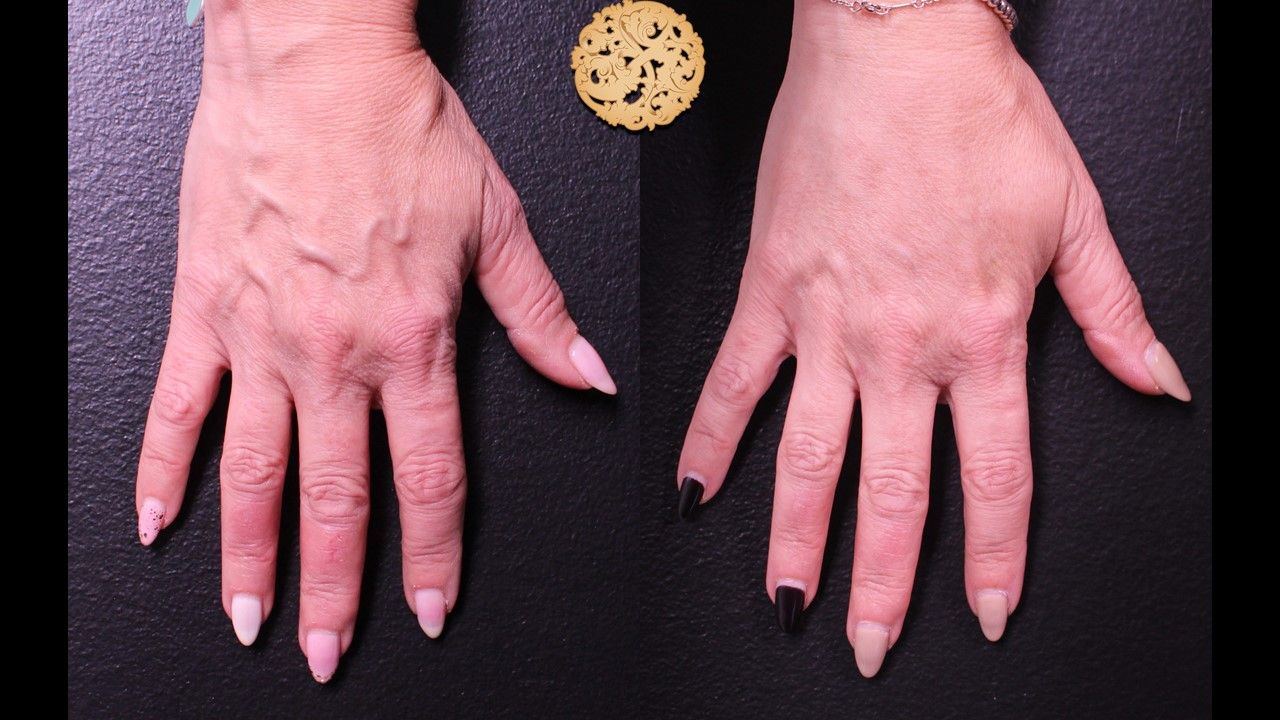 Hand Rejuvenation Before & After