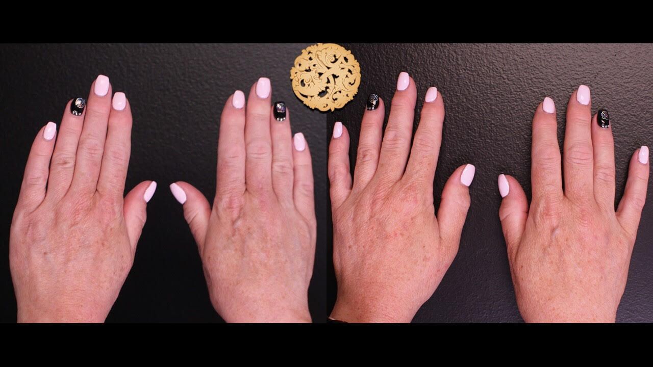 Hand Volume Before & After