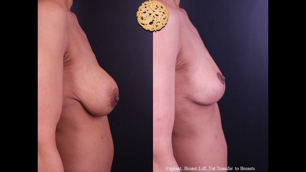 Nipple Reduction Before & After