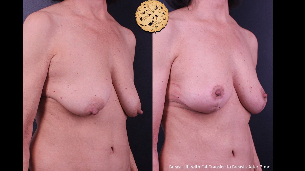 Nipple Reduction Before & After