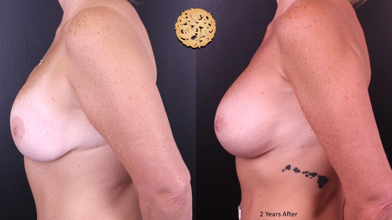 Nipple Reduction Before & After