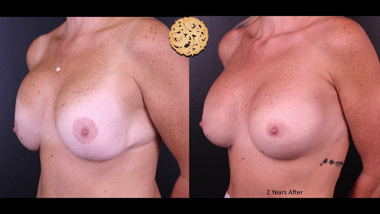 Nipple Reduction Before & After
