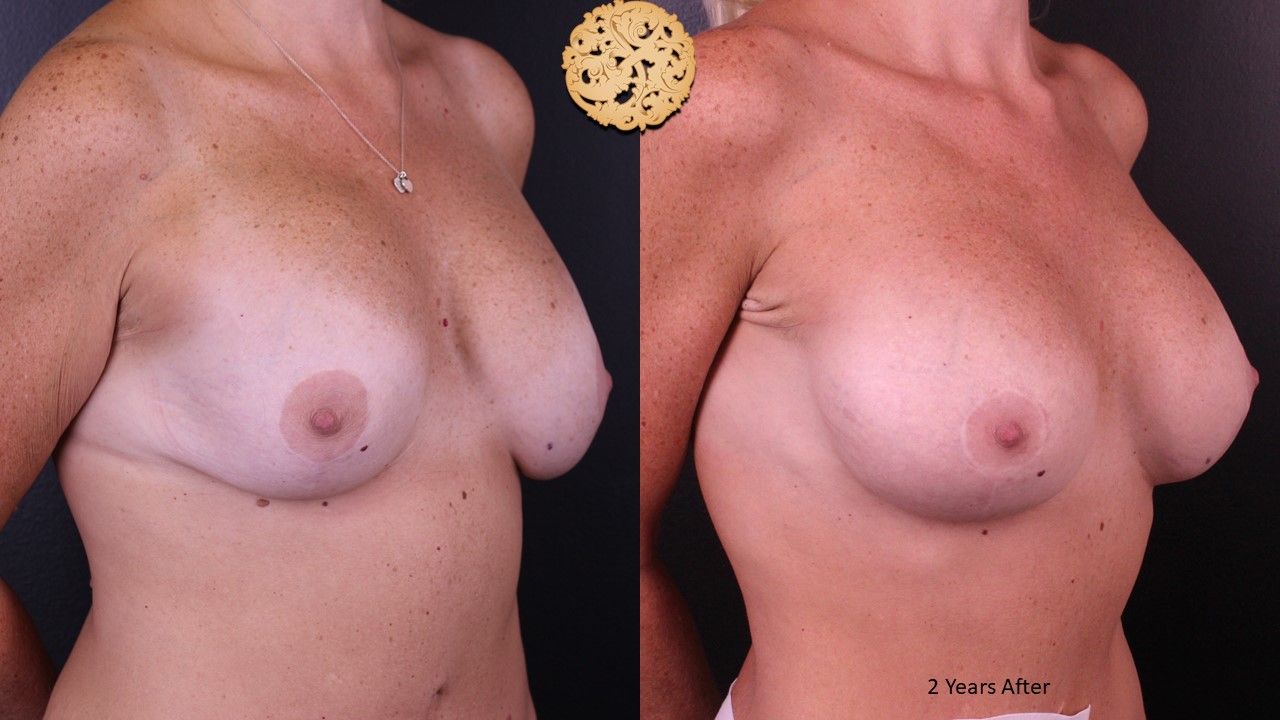 Nipple Reduction Before & After