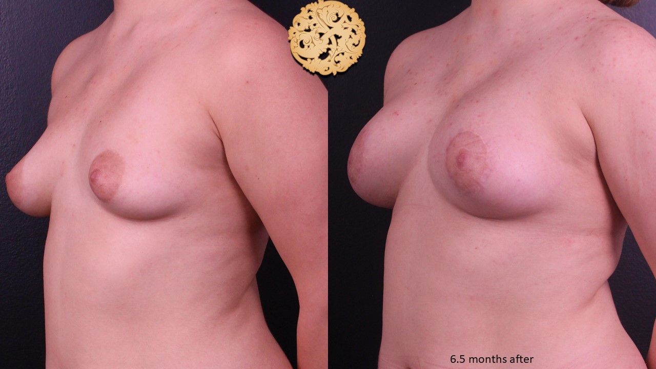 Nipple Reduction Before & After