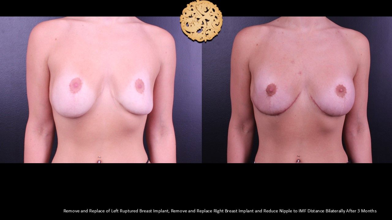 Nipple Reduction Before & After