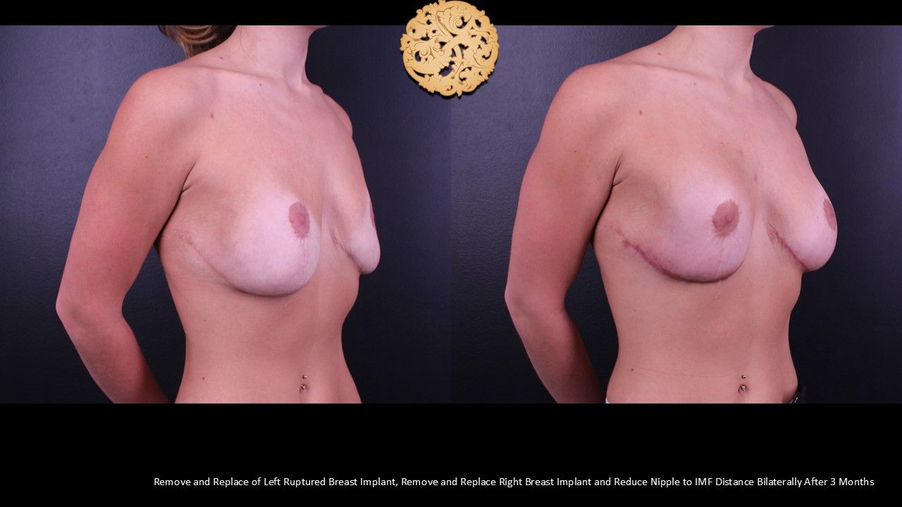 Nipple Reduction Before & After