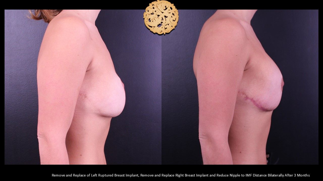 Nipple Reduction Before & After