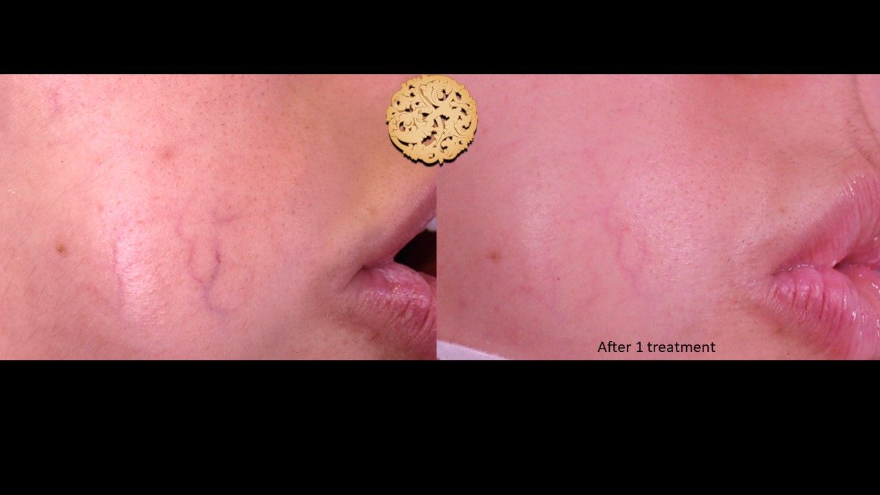 Excel V Before & After