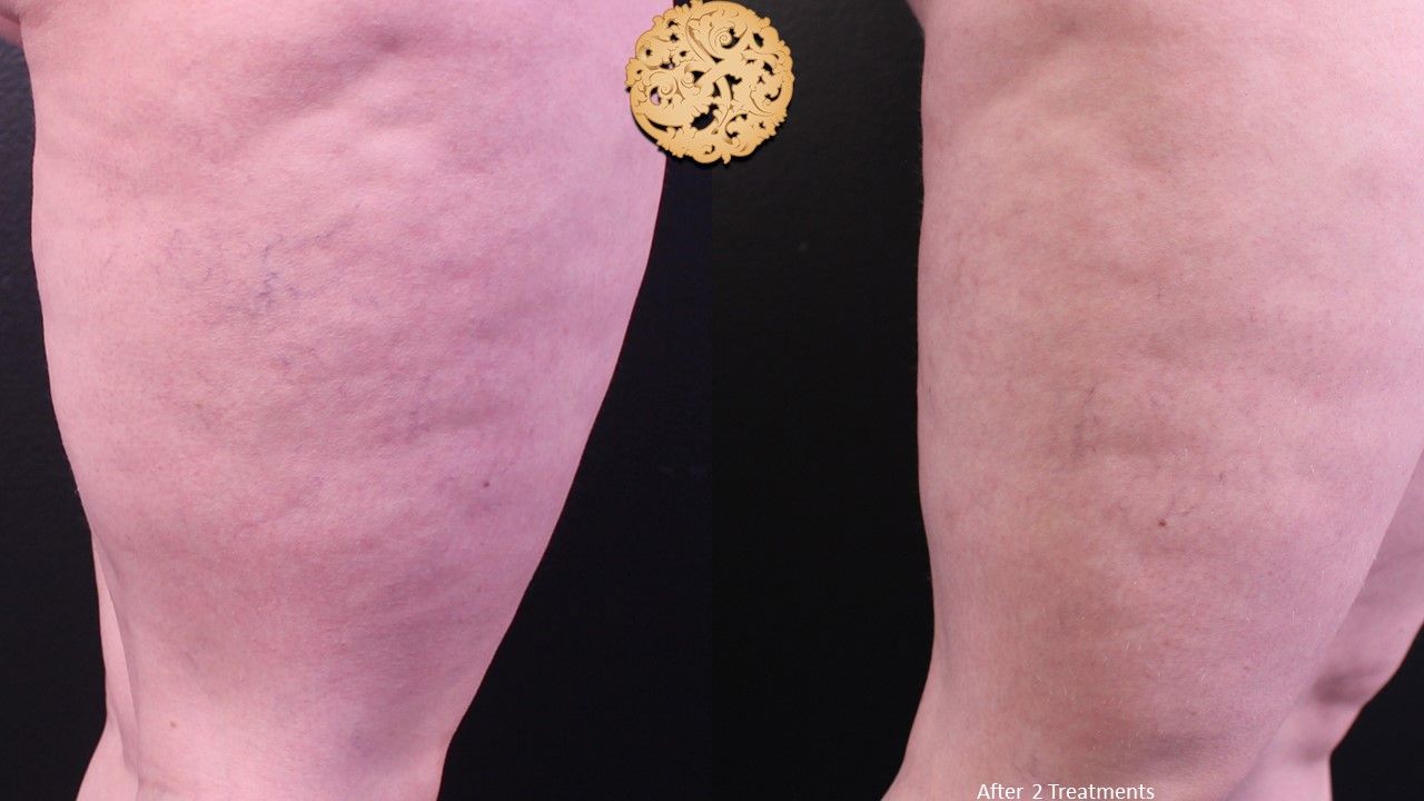 Excel V Before & After