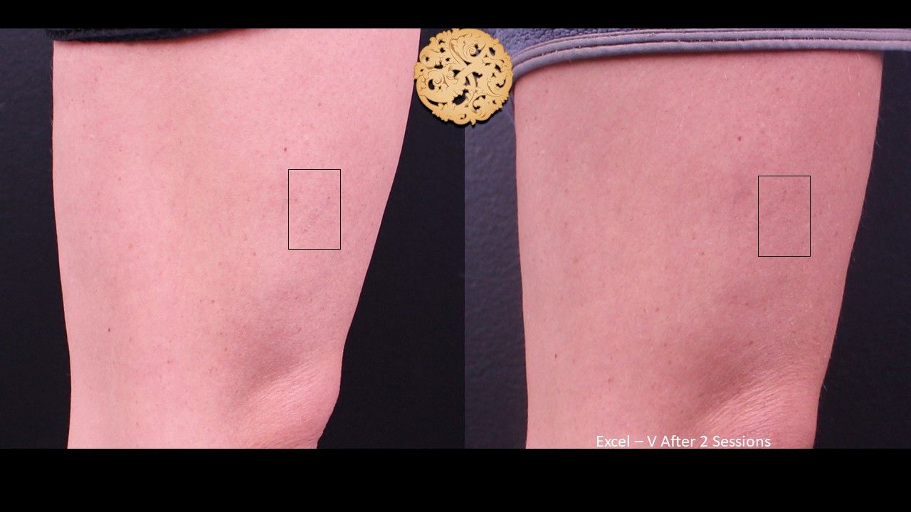 Excel V Before & After