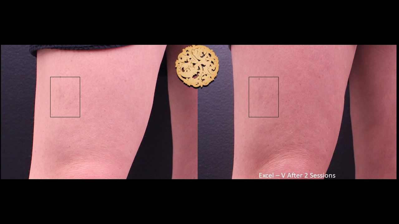 Excel V Before & After