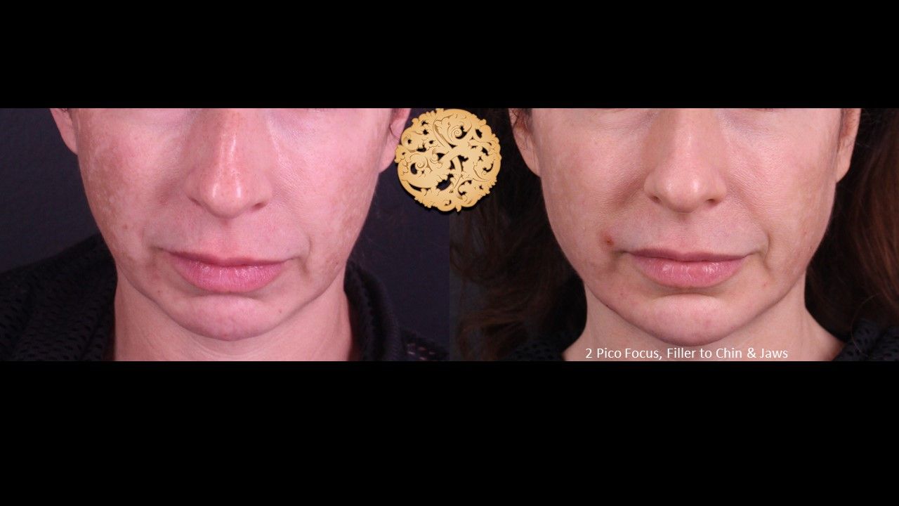 Picofocus Before & After