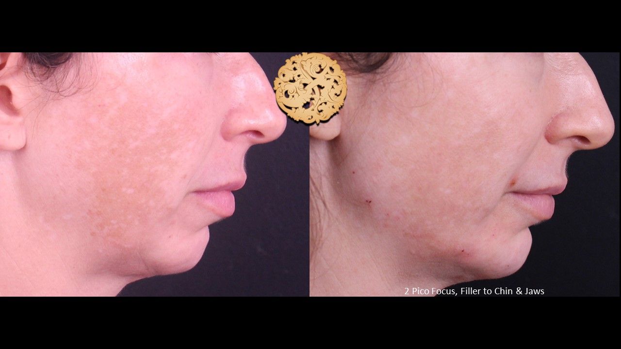 Picofocus Before & After