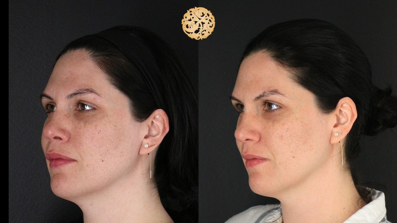 Picofocus Before & After