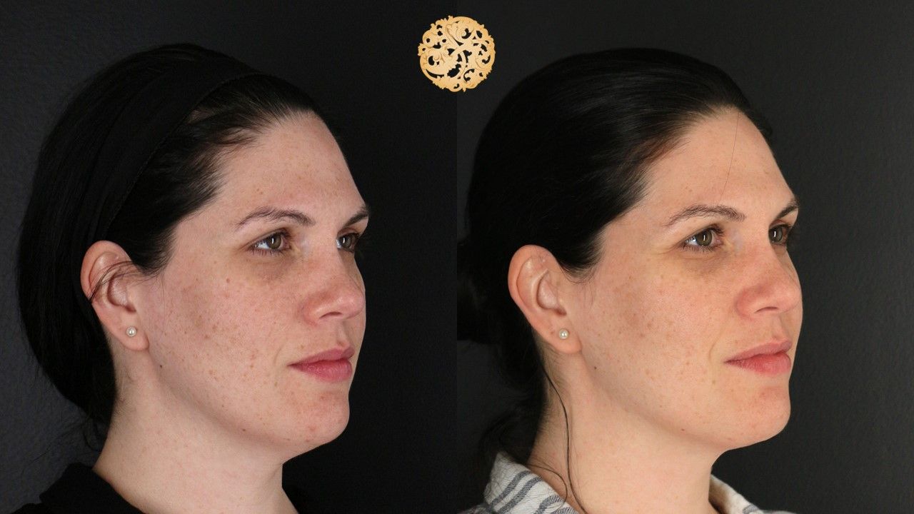 Picofocus Before & After