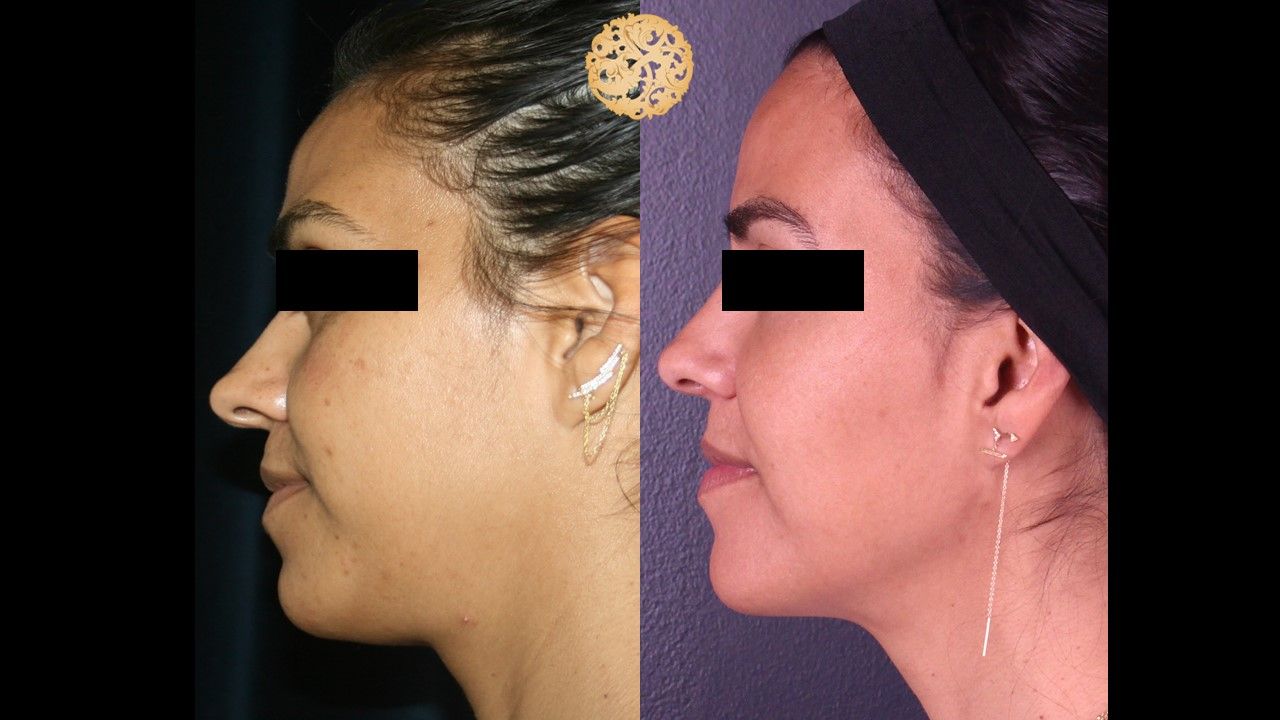 Picofocus Before & After