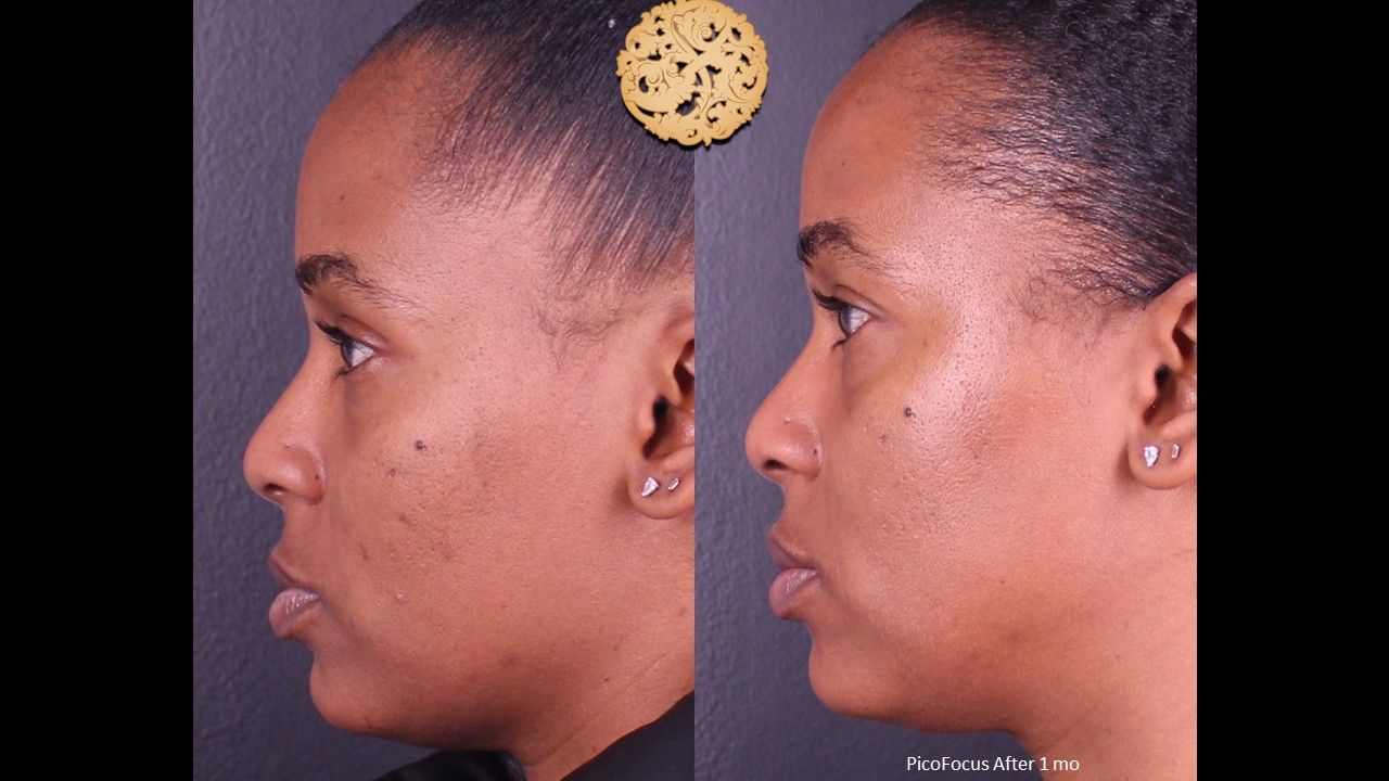 Picofocus Before & After