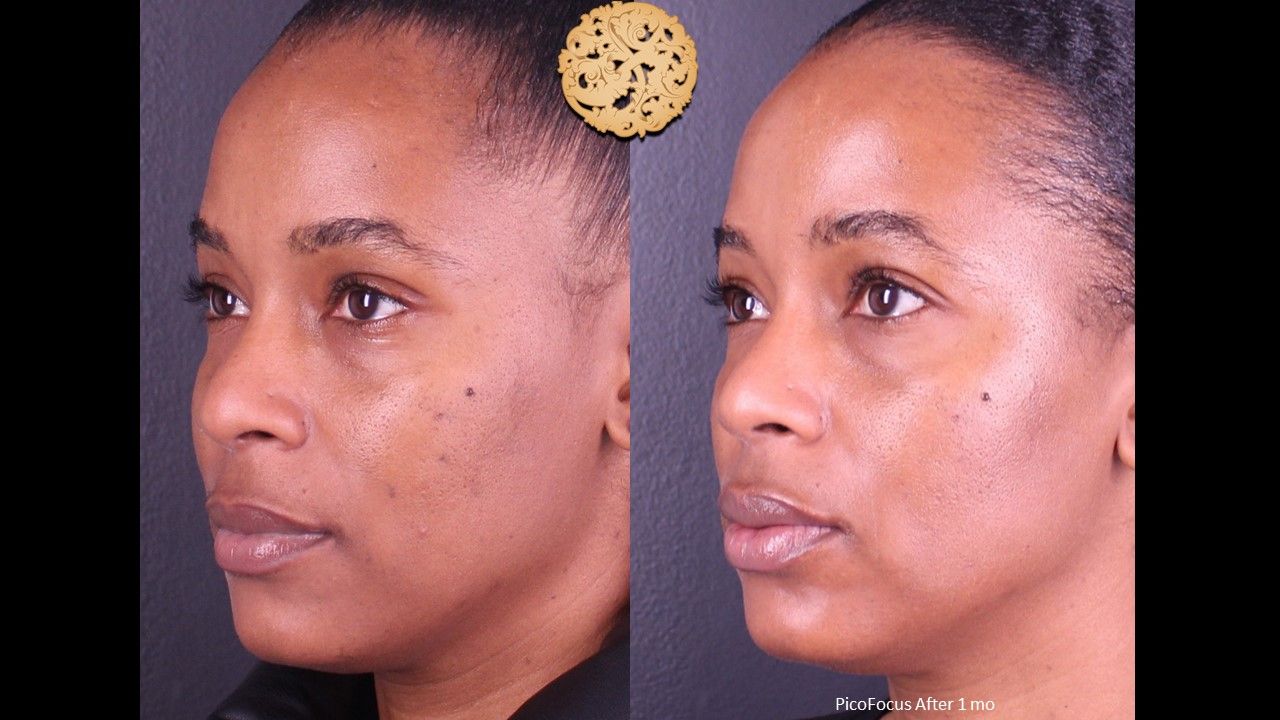 Picofocus Before & After