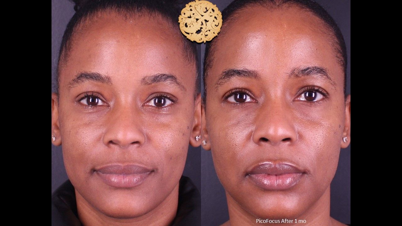 Picofocus Before & After