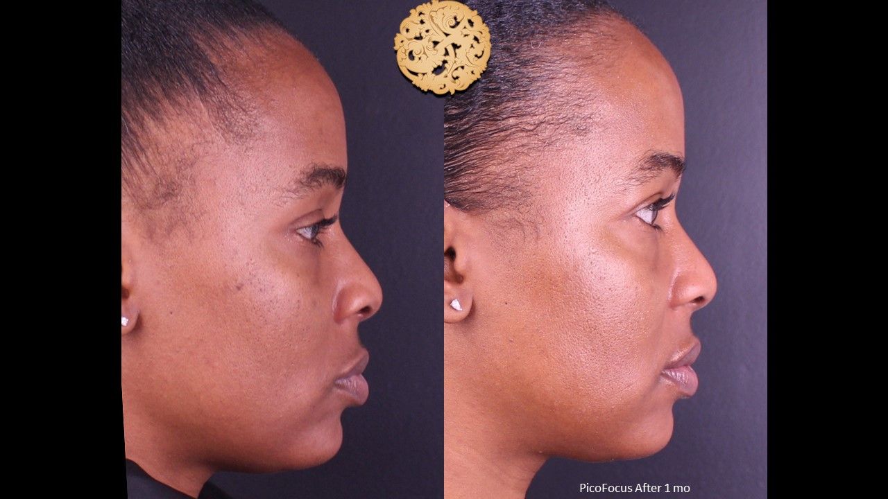 Picofocus Before & After