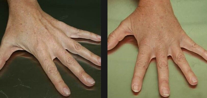 Fat Transfer Hands Before & After