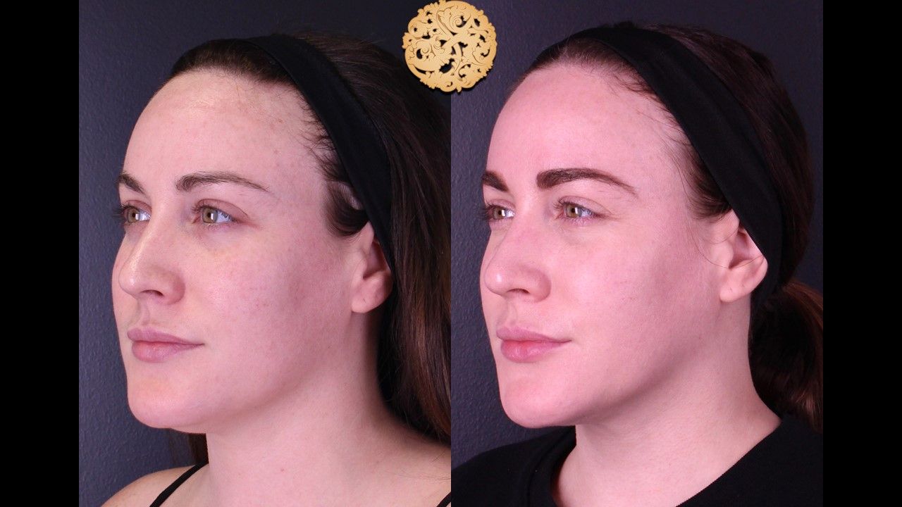 Gold Tip Botox Facial Before & After