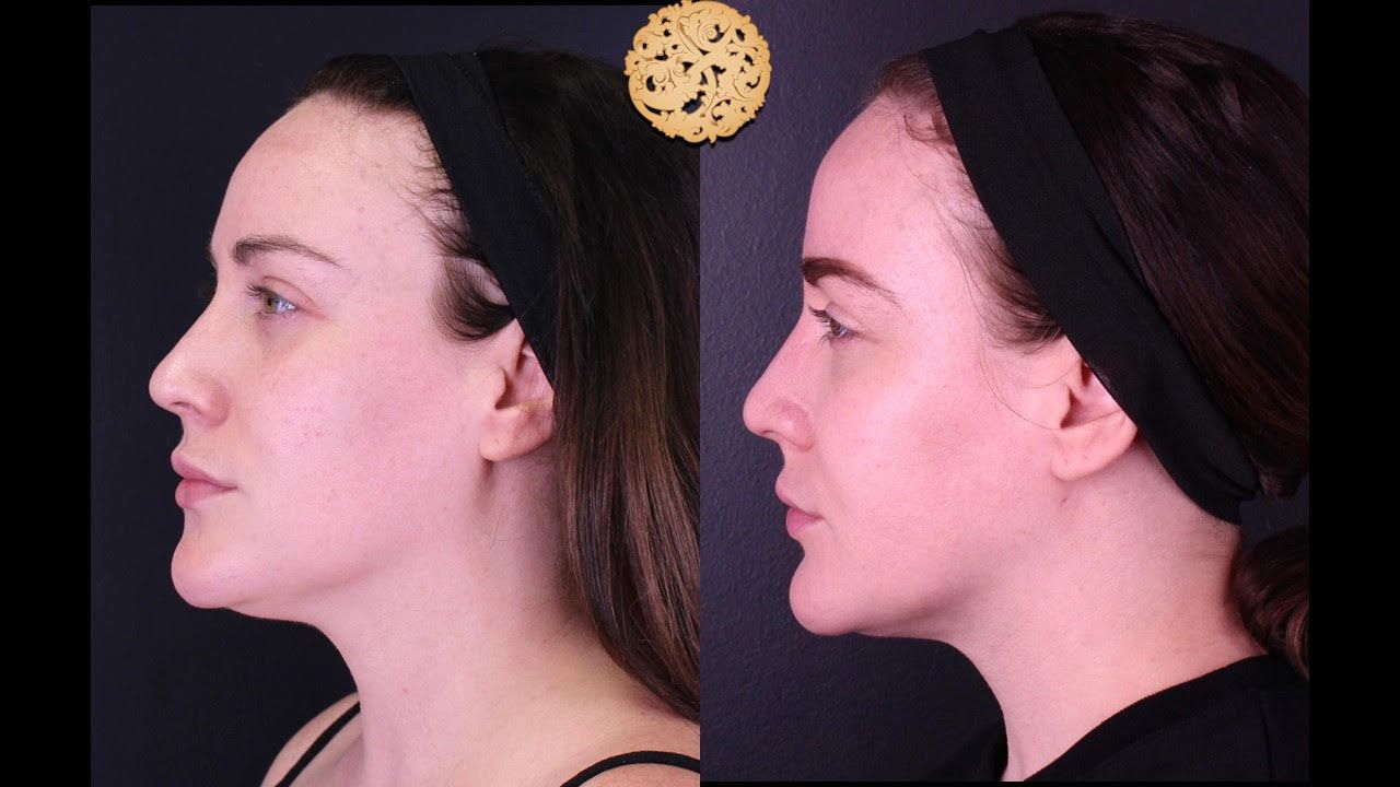 Gold Tip Botox Facial Before & After