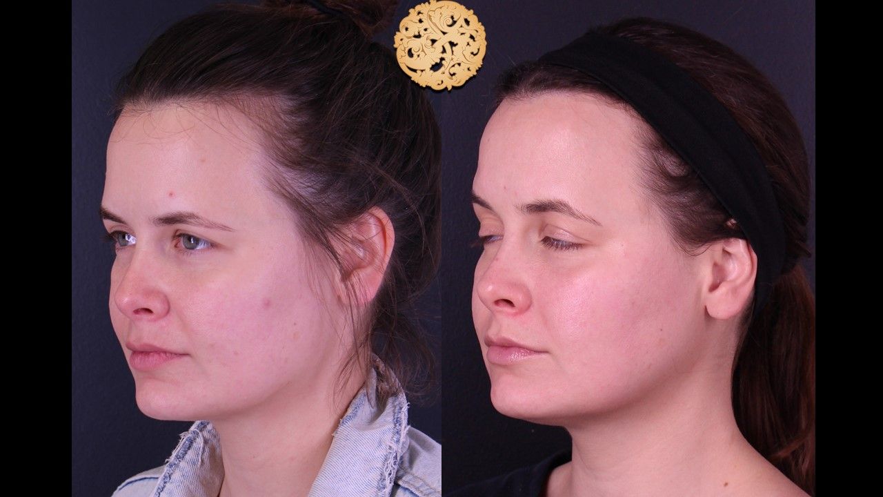 Gold Tip Botox Facial Before & After