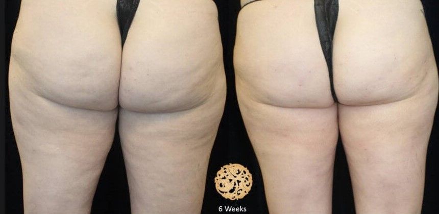 Cellfina Before & After