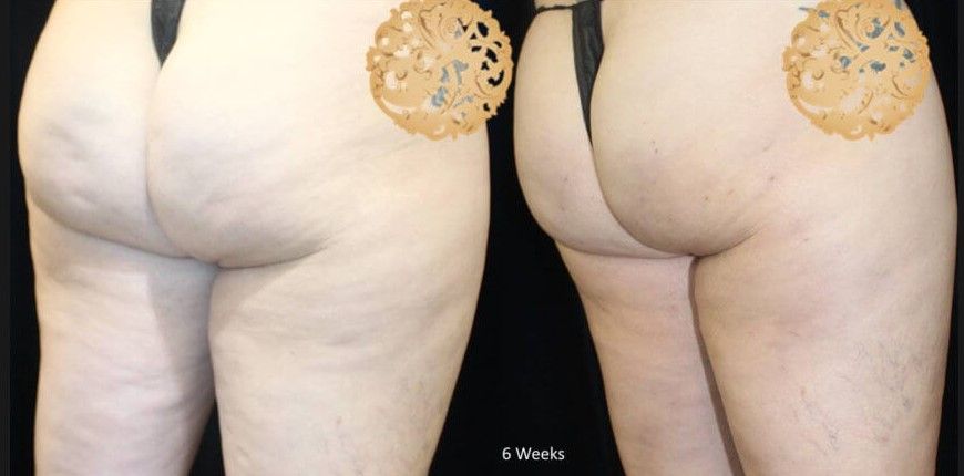 Cellfina Before & After