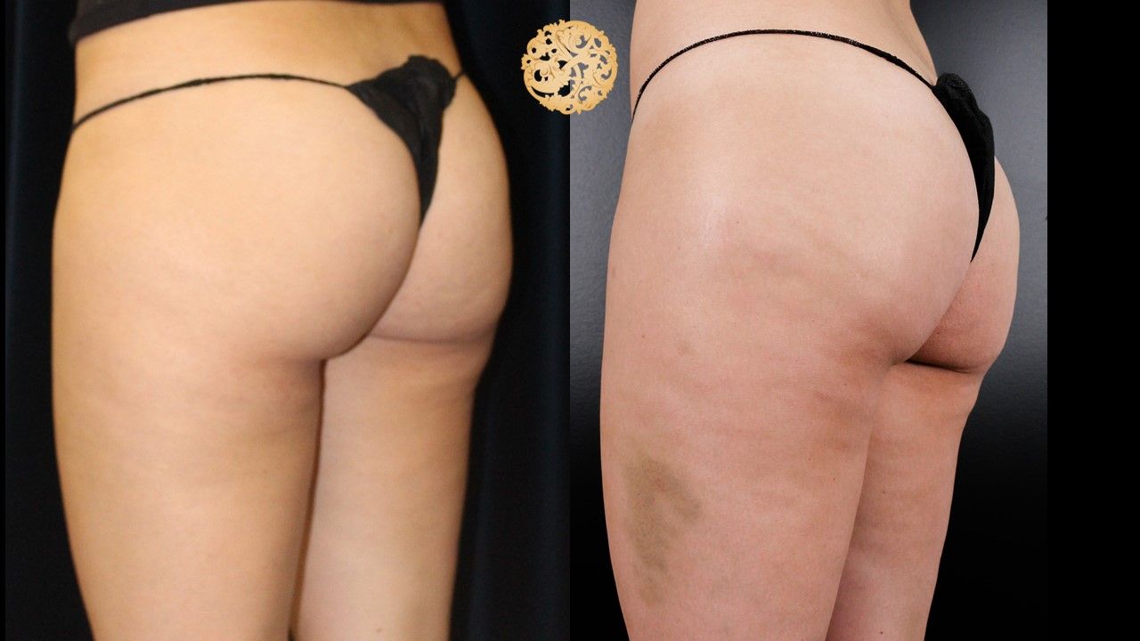 Cellfina Before & After