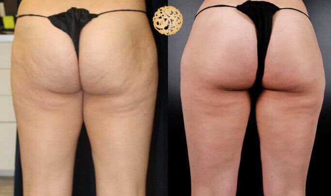 Cellfina Before & After