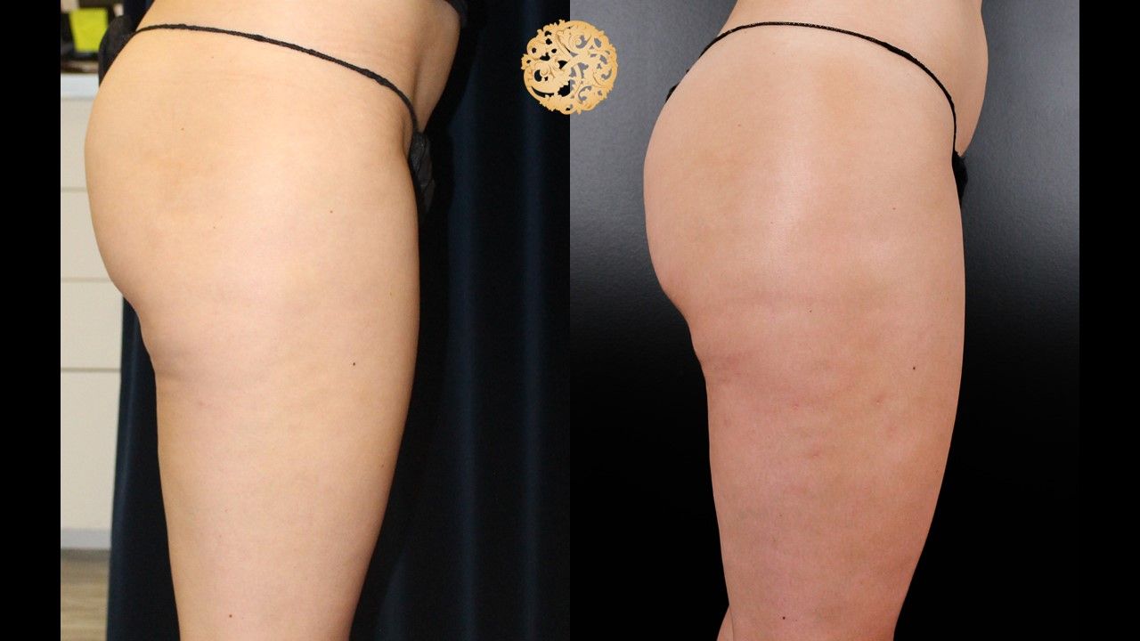 Cellfina Before & After