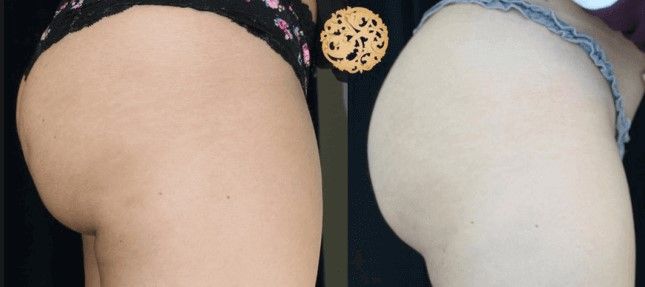 Cellfina Before & After