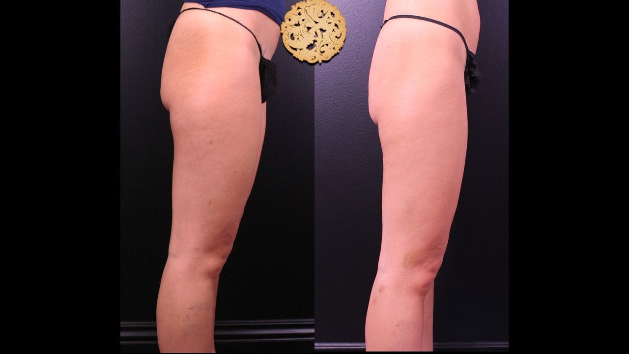 Cellfina Before & After