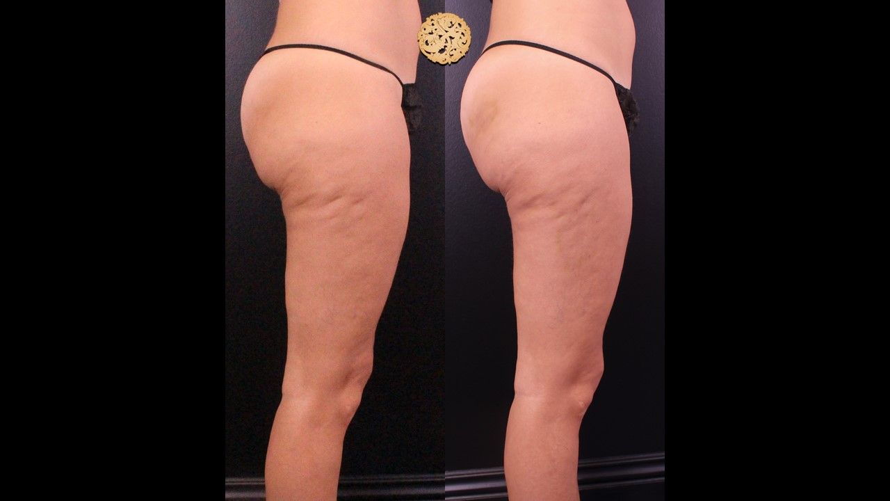 Cellfina Before & After