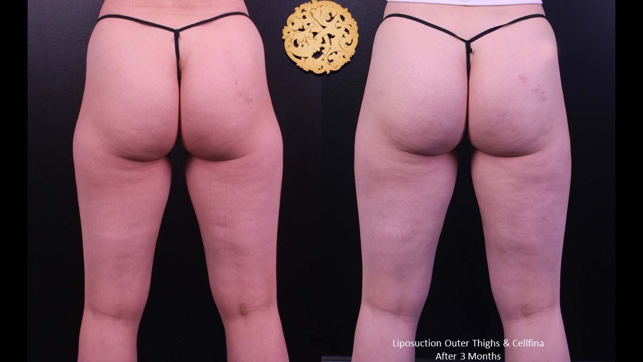 Cellfina Before & After