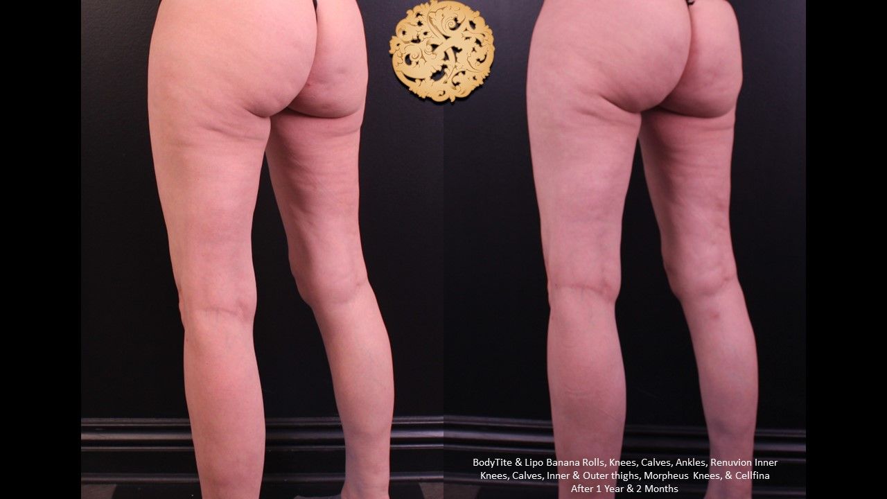 Cellfina Before & After