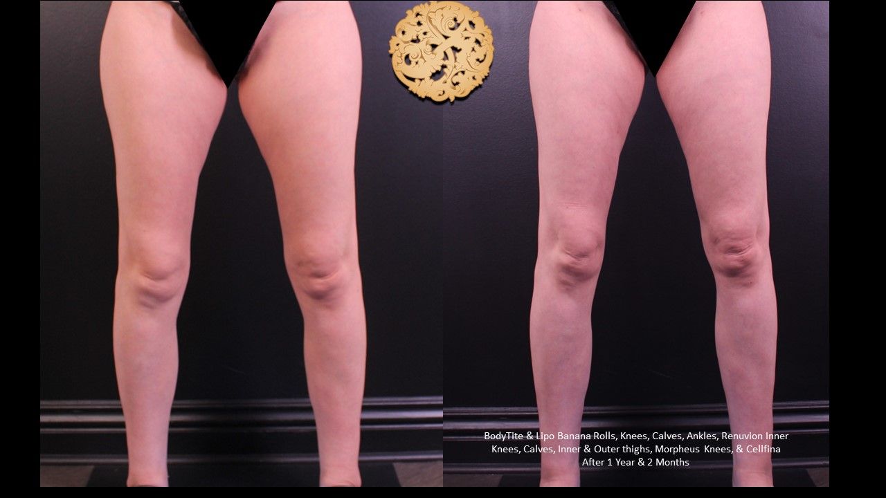 Cellfina Before & After