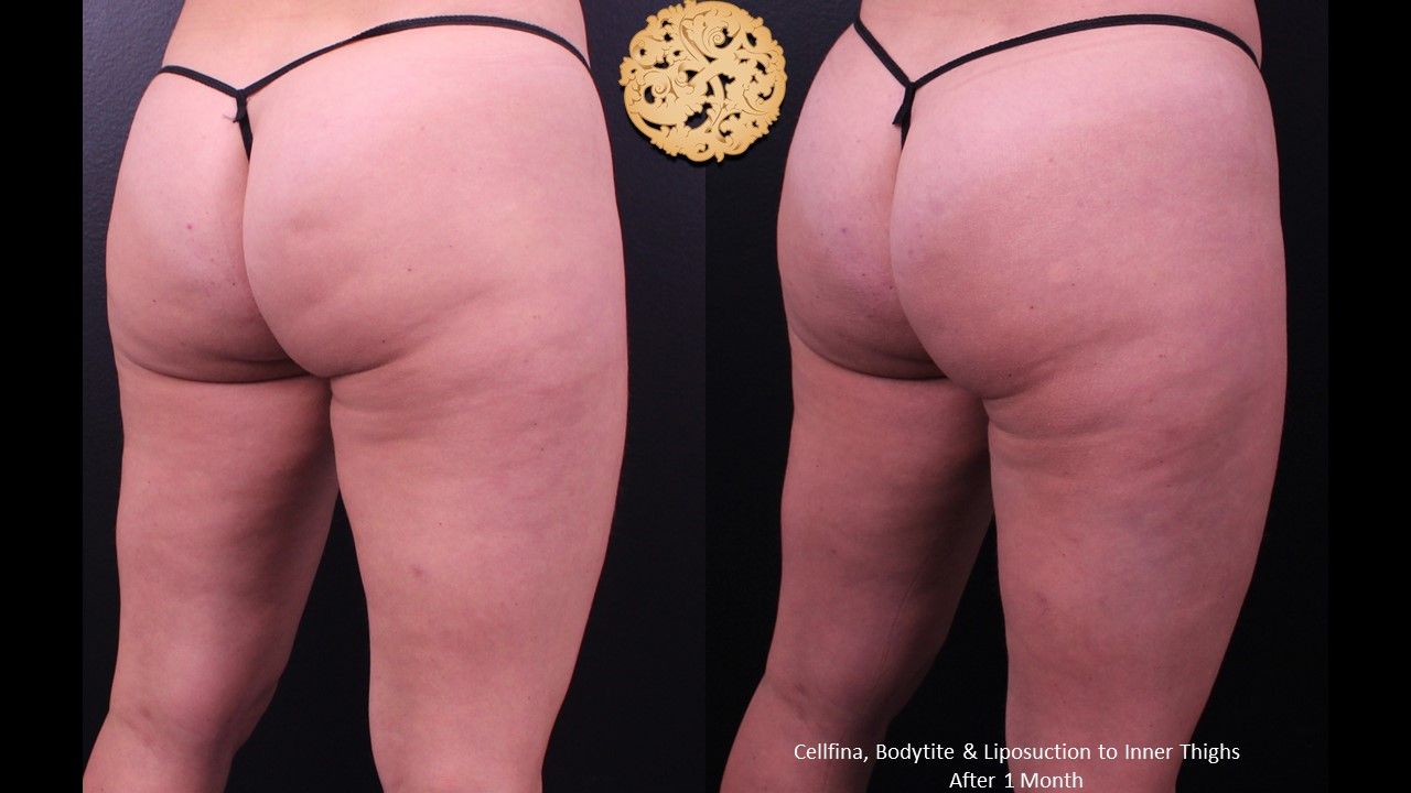 Cellfina Before & After