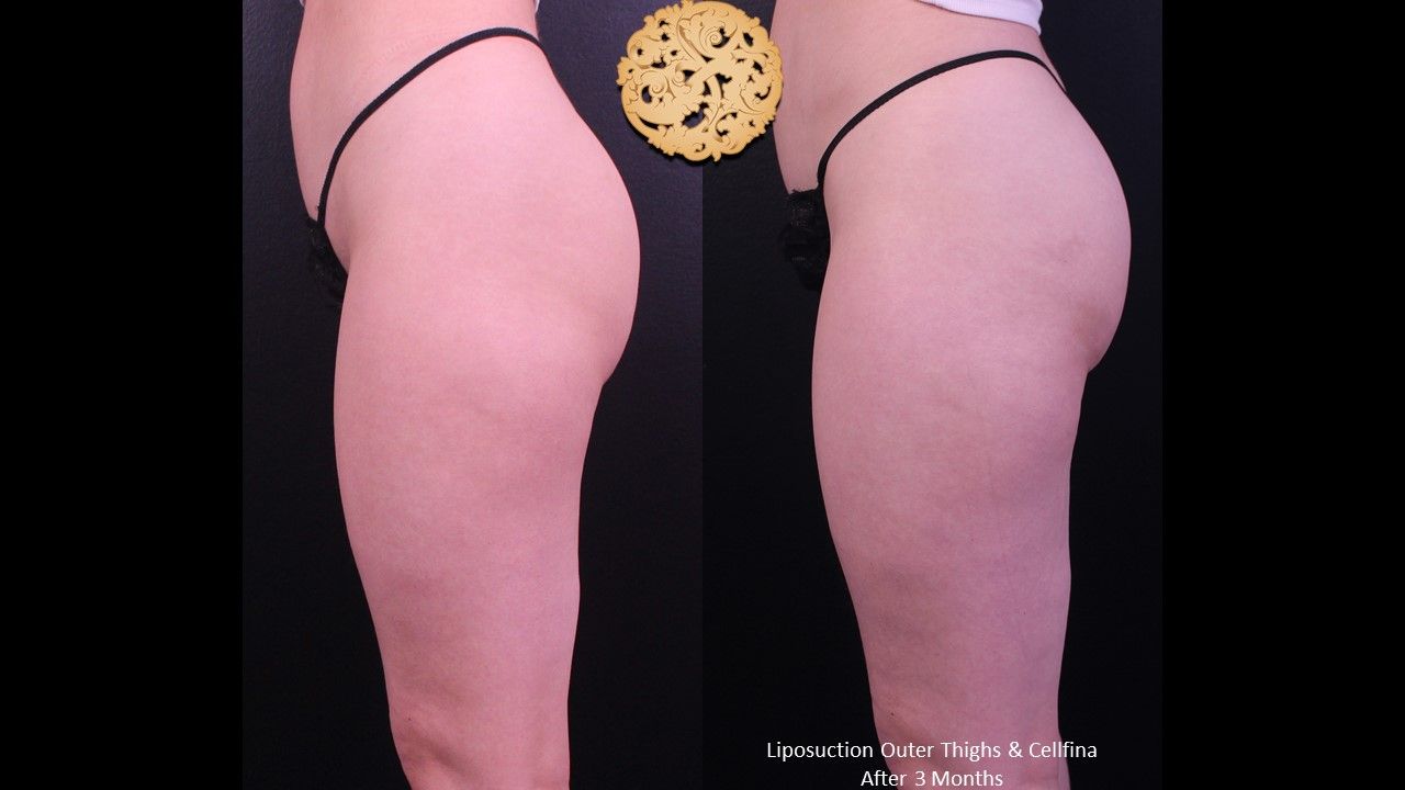 Cellfina Before & After