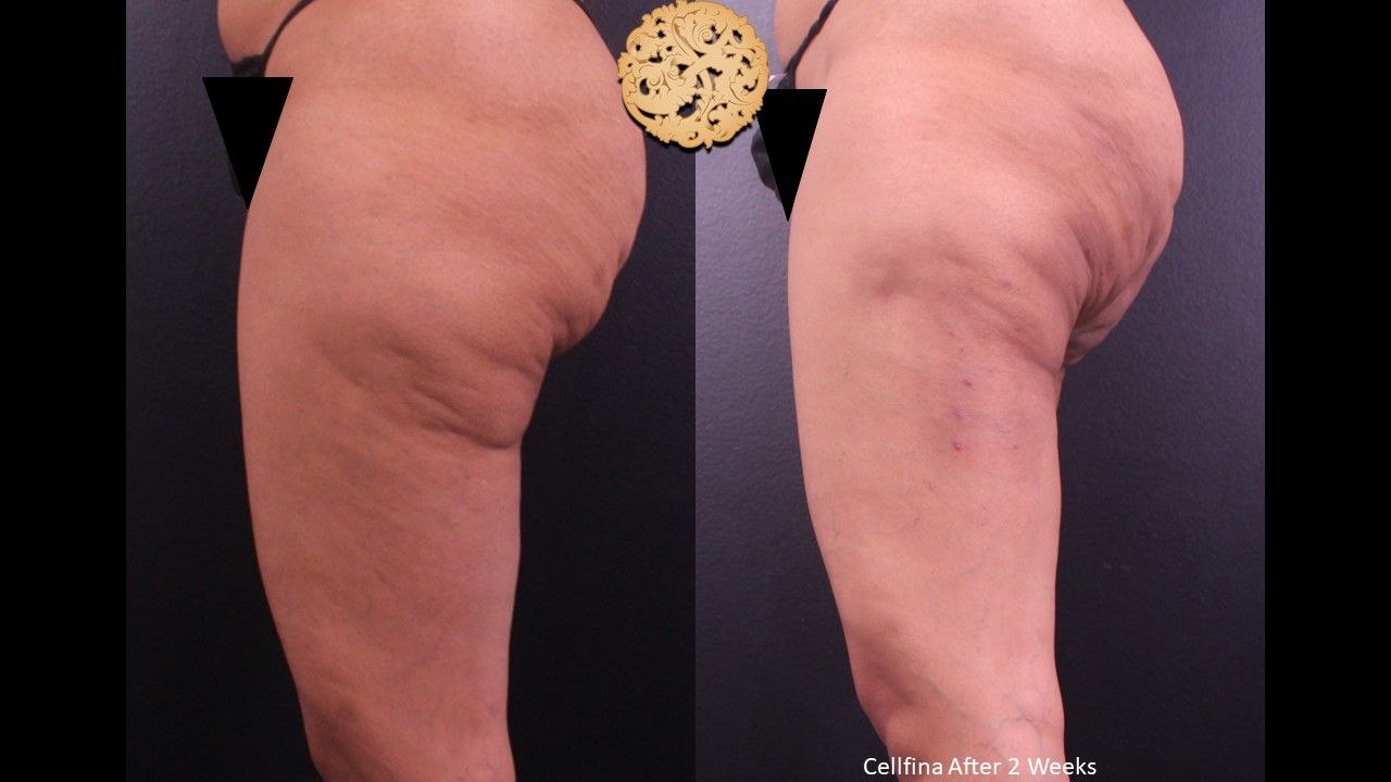 Cellfina Before & After
