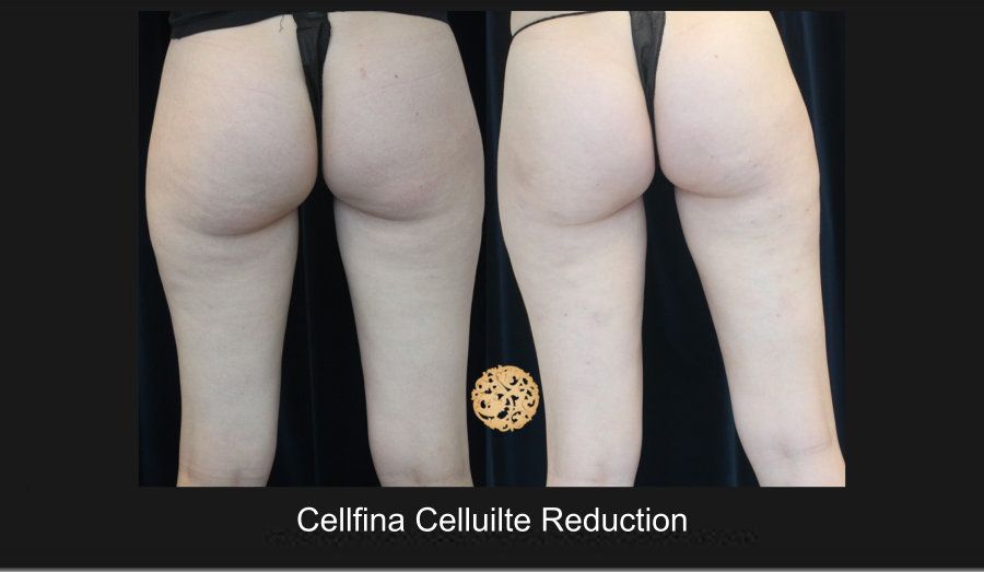 Cellfina Before & After