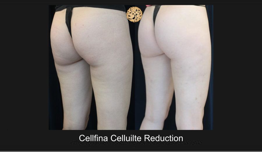 Cellfina Before & After