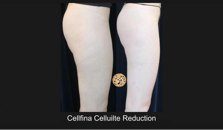 Cellfina Before & After