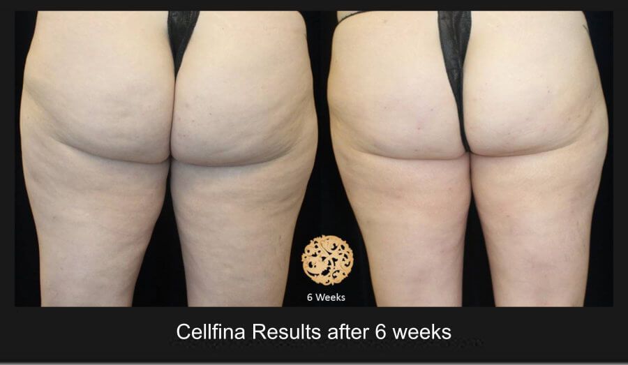 Cellfina Before & After