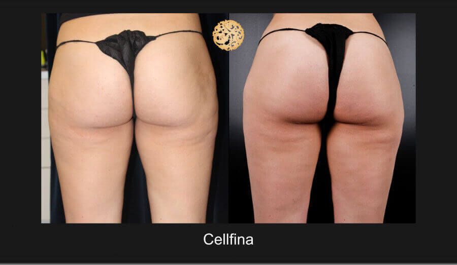 Cellfina Before & After