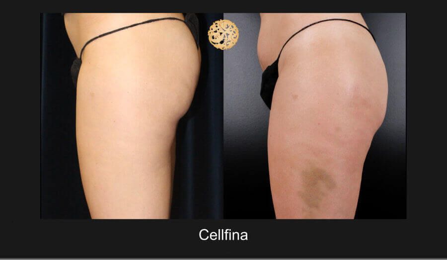 Cellfina Before & After